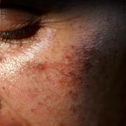 DARK CIRCLES - SIMREE