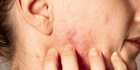 Skincare Red Flags: What Sensitive Skin Should Never Tolerate—Simree's Guide - SIMREE
